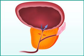 Agrandissement de la prostate et compression de l'urètre