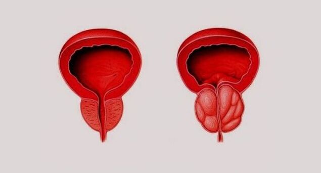 Prostate saine (à gauche) et enflammée à cause d'une prostatite (à droite)