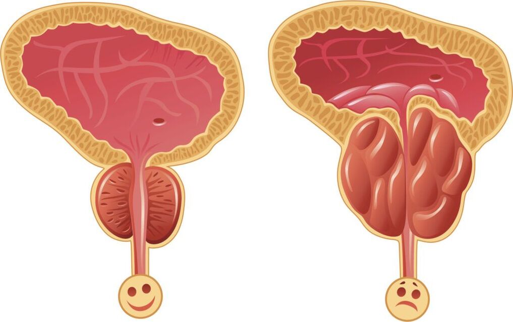 prostate saine et malade