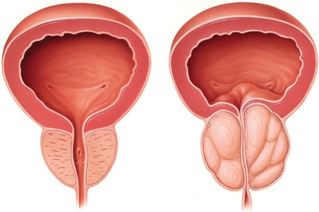 Prostate normale (à gauche) et présentant des signes d'inflammation dans la prostatite (à droite)