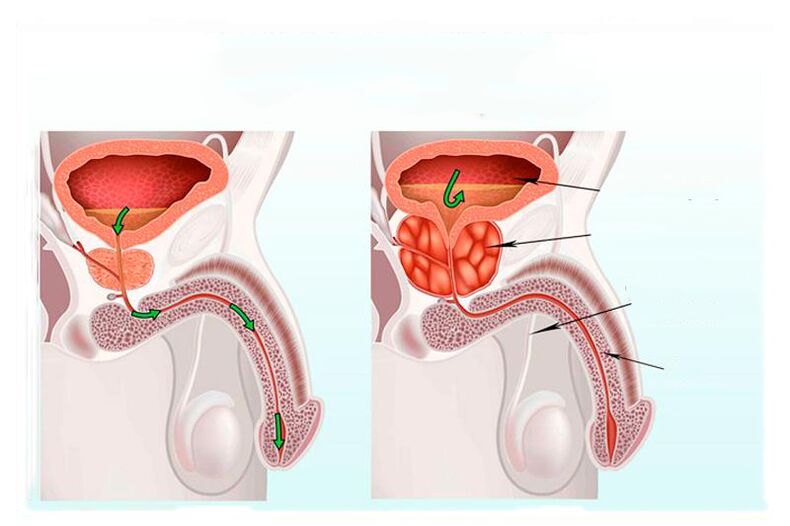 norme et inflammation de la glande de la prostate