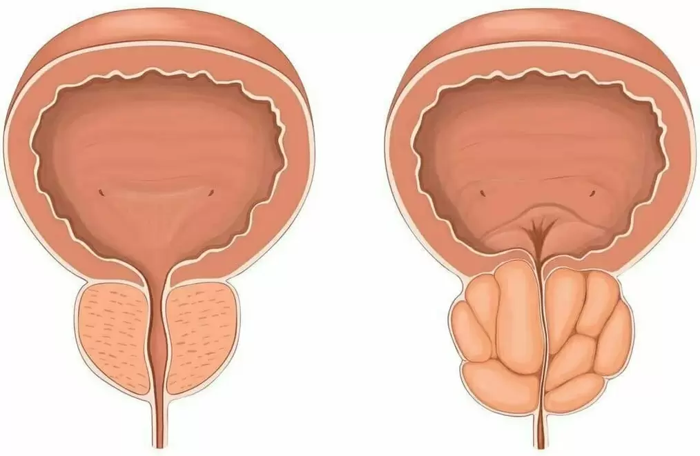 Prostate normal et mal de la prostate