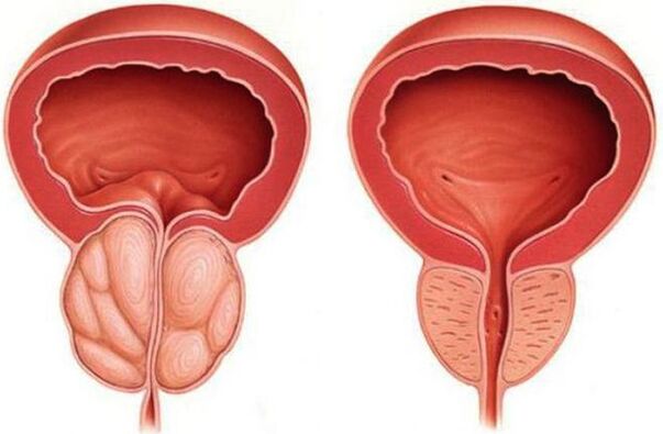 prostate saine et enflammée avec prostatite